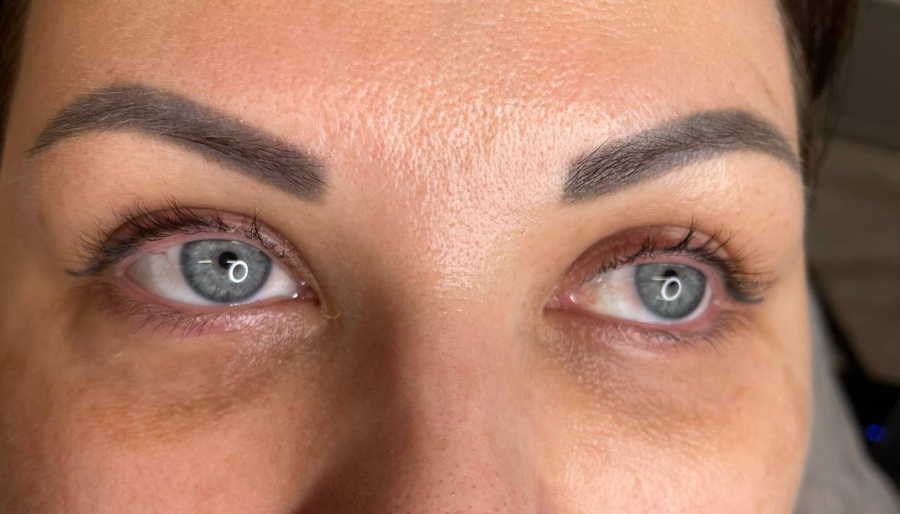 Cernes avant dermopigmentation : rupture de couleur bleu-violet sous l oeil