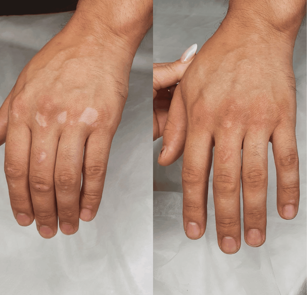 Vitiligo avant apres