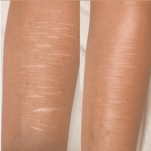 Scarifications avant apres